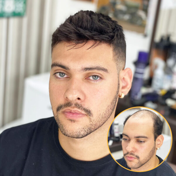 Before and after a man puts on a LIGHT03 thin skin hair system