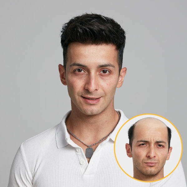 MF1 Fine Mono Hair System with a Thin Skin Perimeter (9)